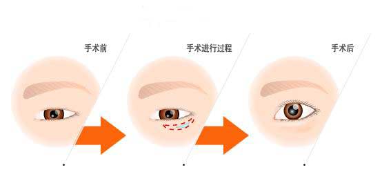 去眼袋手术,整形美容医院,眼皮外翻怎么修复
