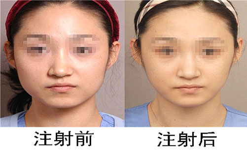 深圳打瘦脸针哪家整形美容医院比较好?