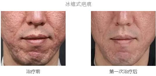 整形美容医院在线分析影响黄金射频效果因素
