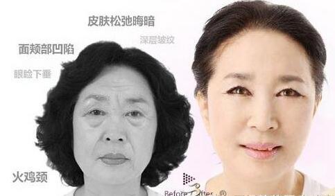 botox,botox除皱