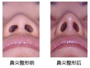 深圳整形,鼻尖整形手术,鼻尖整形手术需要多少钱