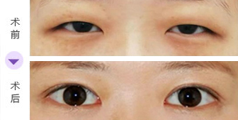 韩式双眼皮手术哪家整形美容医院做好? 韩式双眼皮手术哪家整形美容医院做好?