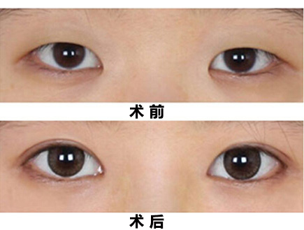 割双眼皮深圳较好的整形美容医院有哪一家?